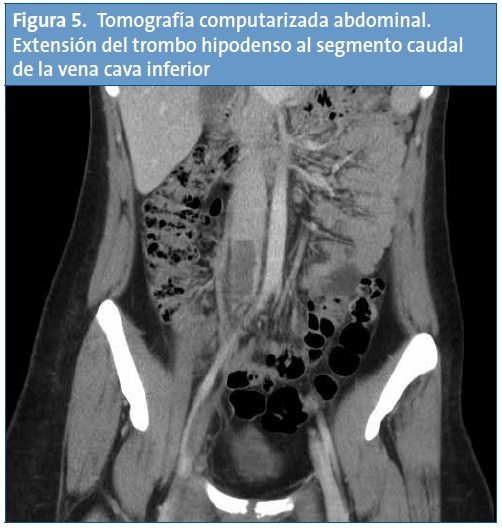 Figura 5. Tomografía computarizada abdominal. Extensión del trombo hipodenso al segmento caudal de la vena cava inferior