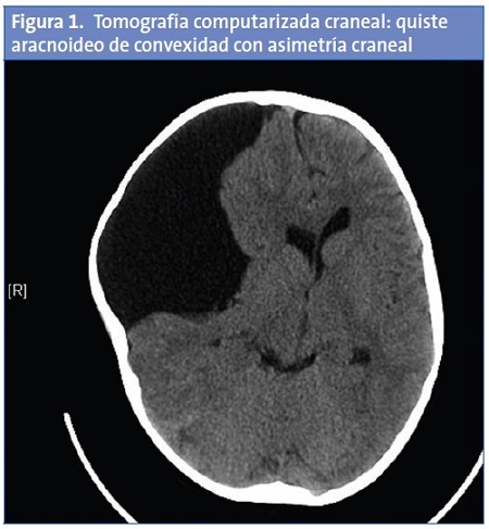 Figura 1. Tomografía computarizada craneal: quiste aracnoideo de convexidad con asimetría craneal