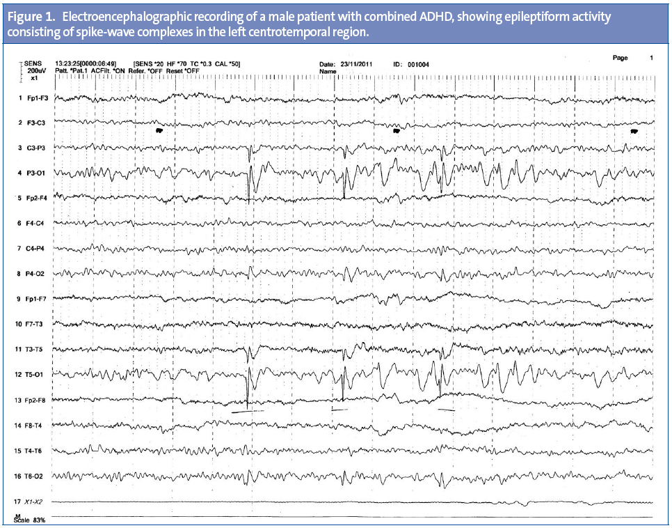Figure 1. Electroencephalographic recording of a male patient with combined ADHD, showing epileptiform activity consisting of spike-wave complexes in the left centrotemporal region.