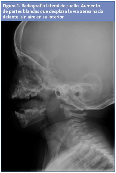 Figura 1. Radiografía lateral de cuello. Aumento de partes blandas que desplaza la vía aérea hacia delante, sin aire en su interior