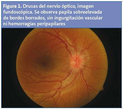Figura 1. Drusas del nervio óptico, imagen fundoscópica. Se observa papila sobreelevada de bordes borrados, sin ingurgitación vascular ni hemorragias peripapilares.