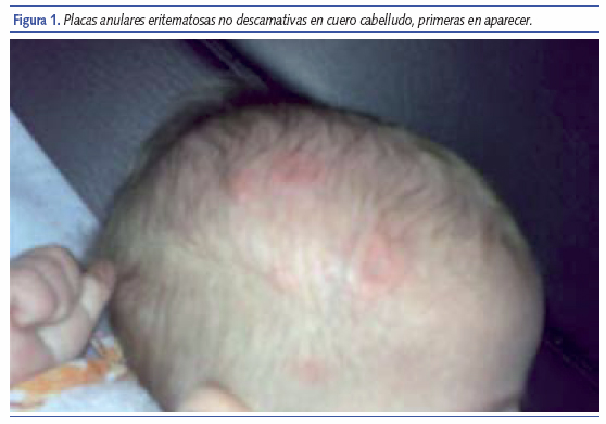 Placas anulares eritematosas no descamativas en cuero cabelludo, primeras en aparecer