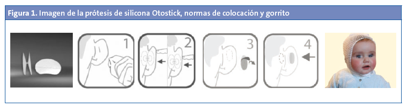 Figura 1. Imagen de la prótesis de silicona Otostick, normas de colocación y gorrito