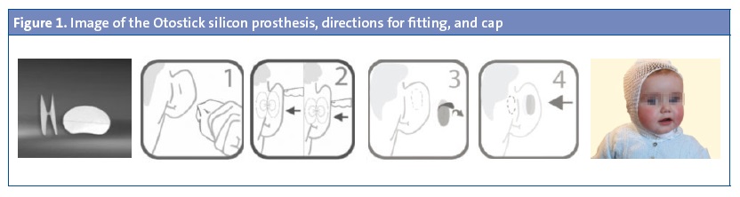 Figure 1. Image of the Otostick silicon prosthesis, directions for fitting, and cap
