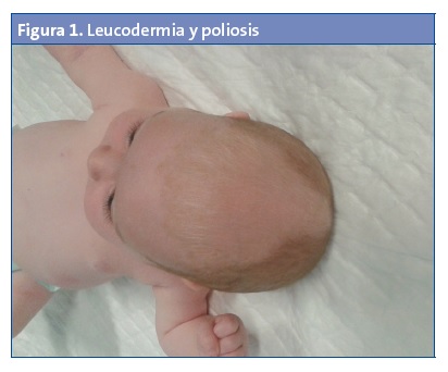 Figura 1. Leucodermia y poliosis