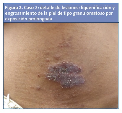 Figura 2. Caso 2: detalle de lesiones: liquenificación y engrosamiento de la piel de tipo granulomatoso por exposición prolongada