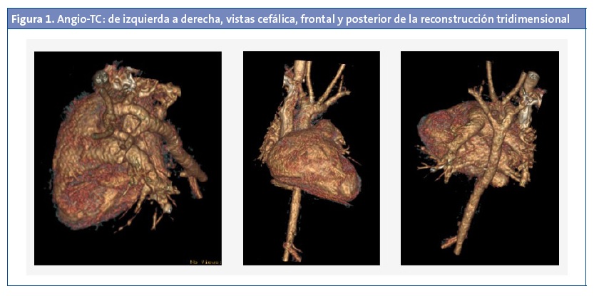 Figura 1. Angio-TC: de izquierda a derecha, vistas cefálica, frontal y posterior de la reconstrucción tridimensional