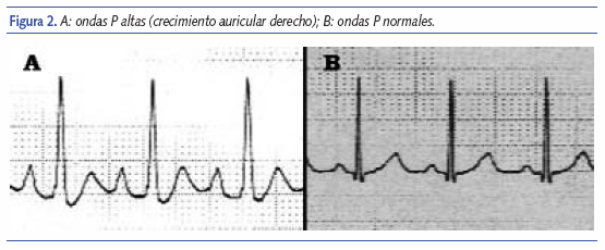 A: ondas P altas (crecimiento auricular derecho); B: ondas P normales