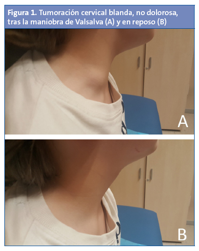 Figura 1. Tumoración cervical blanda, no dolorosa, tras la maniobra de Valsalva (A) y en reposo (B)