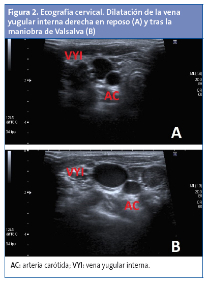 Figura 2. Ecografía cervical. Dilatación de la vena yugular interna derecha en reposo (A) y tras la maniobra de Valsalva (B)
