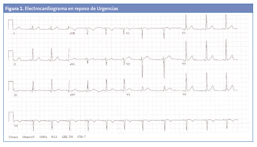 Figura 1. Electrocardiograma en reposo de Urgencias
