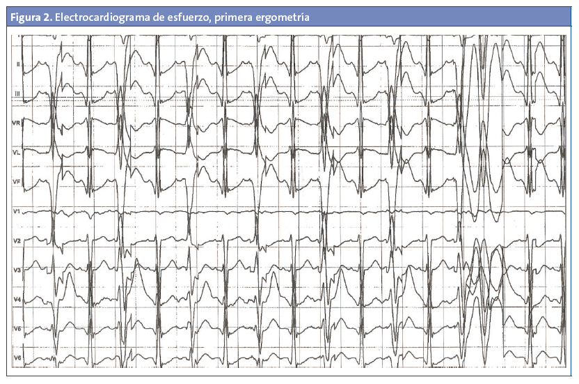 Figura 2. Electrocardiograma de esfuerzo, primera ergometría