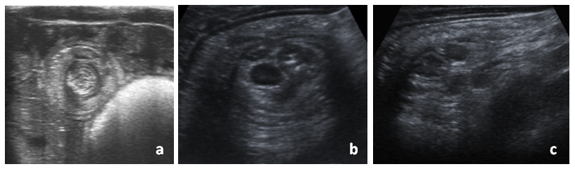 Figure 1. Ultrasound images of intussusception: a) transverse view of ileoileal intussusception (doughnut or target sign); b) transverse view of ileocolic intussusception, containing enlarged lymph nodes; c) longitudinal view of ileocolic intussusception (pseudokidney sign)