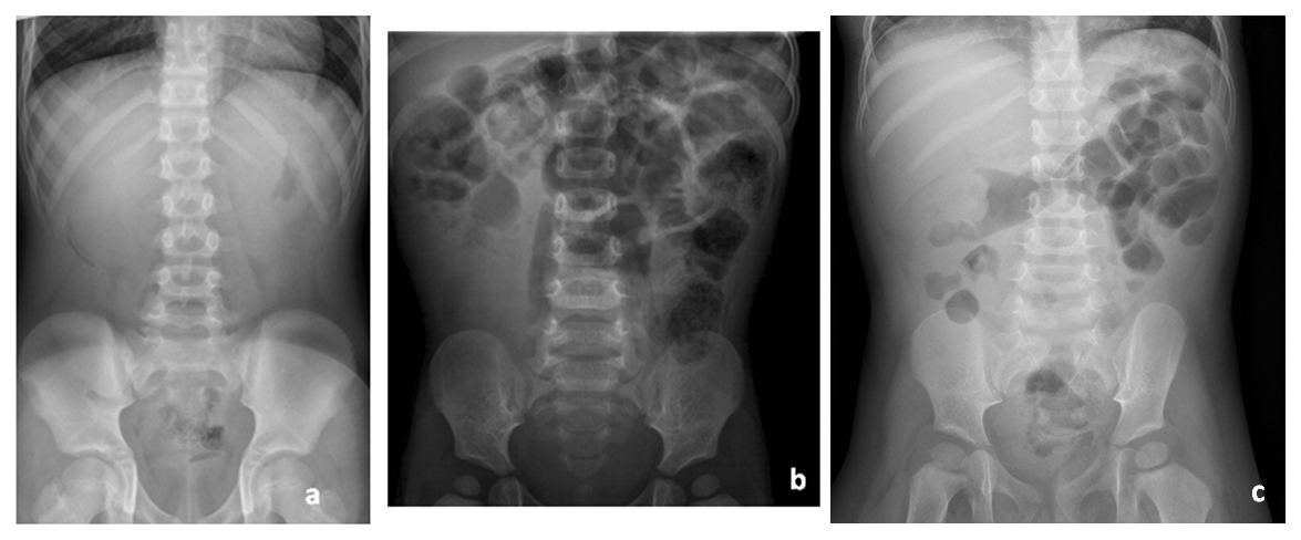 Figure 2. Abdominal X-ray in patients with intussusception: a) silent abdomen; b) absence of air in the right bowel; c) intussusceptum at the level of the hepatic flexure