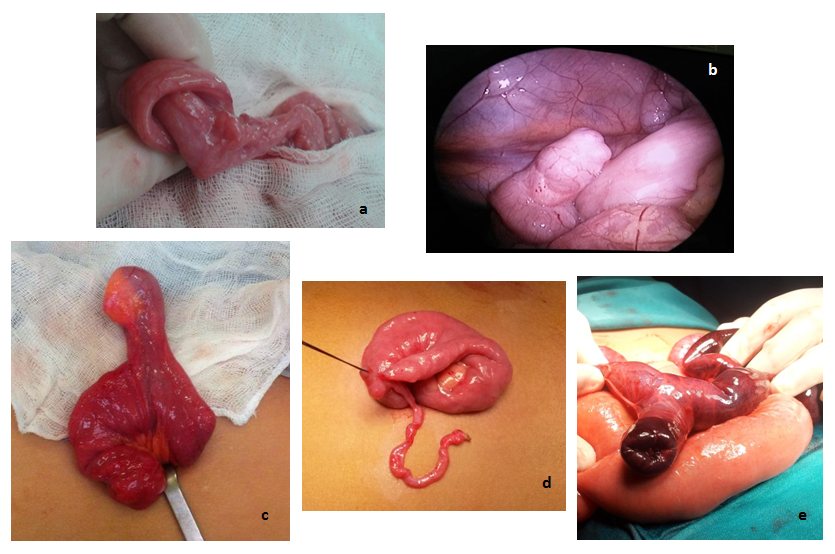 Figure 4. Surgical images: a) intussusception; b) Meckel’s diverticulum, found by laparoscopy; c) Meckel’s diverticulum exposed through an umbilical incision; d) continuation of Meckel’s diverticulum with obliterated vitelline duct; e) Meckel’s diverticulum complicated by intussusception