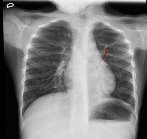 Figura 2. Imagen redondeada en vértice pulmonar izquierdo, de bordes finos y bien delimitados, de 43 × 31 mm; compatible con neumatocele