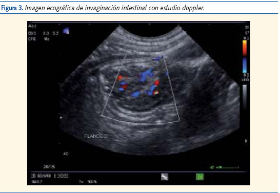 Figura 3. Imagen ecográfica de invaginación intestinal con estudio doppler.