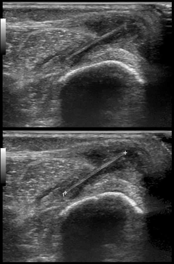 Figura 2. Ecografía de partes blandas donde se identifica una lesión sólida lineal hiperecogénica con sombra posterior, imagen característica de espina de palmera