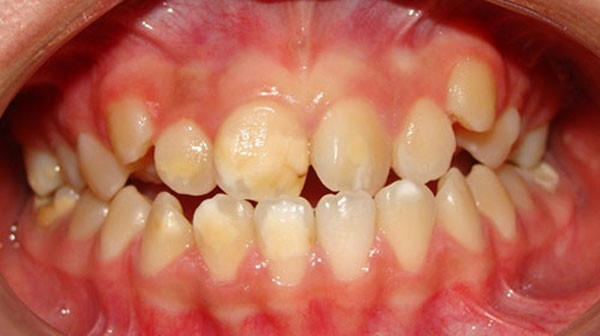 Figura 1. Opacidades en los incisivos y molares permanentes