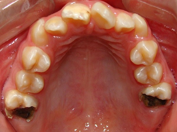 Figura 2. Fotografía oclusal: hipomineralización grave, en la que se observa la destrucción de los molares afectados