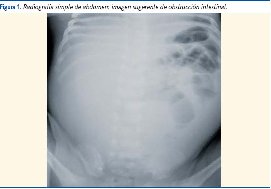 Figura 1. Radiografía simple de abdomen: imagen sugerente de obstrucción intestinal.