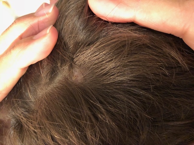 Pequeña zona alopécica en cuero cabelludo