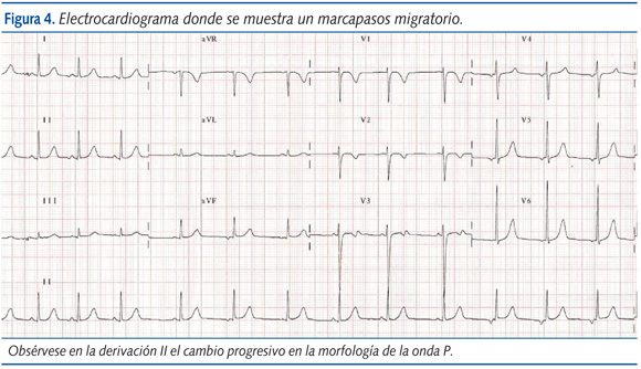 Figura 4. Electrocardiograma donde se muestra un marcapasos migratorio.
