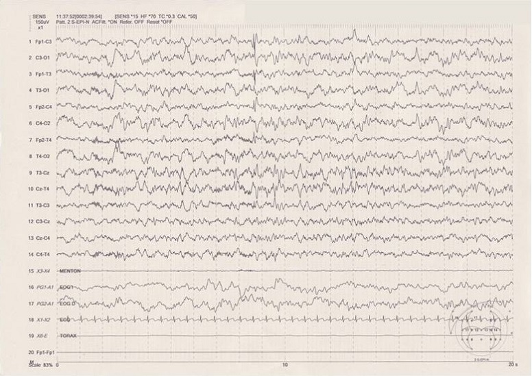 Figura 1. EEG de sueño diurno. Actividad punta onda aguda sobre regiones centrales en sueño nREM
