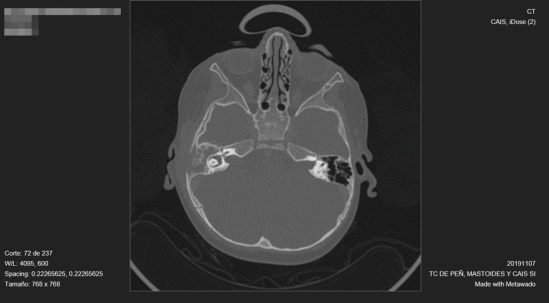 Figura 1. Tomografía computarizada. Intensa destrucción ósea del conducto auditivo, oído medio y mastoides derechas