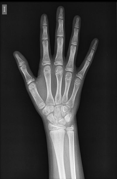 Figura 1. Radiografía de mano y muñeca izquierdas. Edad ósea de diez años (Atlas Greulich y Pyle)