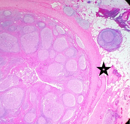 Figura 1. Anatomía patológica de apéndice cecal. Visión panorámica de un corte sagital histológico del apéndice, donde puede observarse (4×, tinción hematoxilina-eosina) la oclusión casi completa de la luz (estrella negra) y la masiva presencia de folículos linfoides en mucosa, submucosa y muscular interna, con centros germinales reactivos y heterogeneidad de tamaños y formas