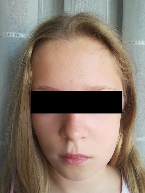 Hinchazón de región facial izquierda correspondiente a enfisema subcutáneo