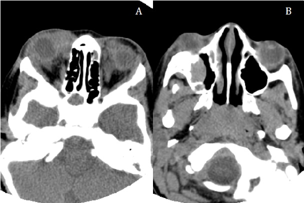 Cortes axiales de la tomografía computarizada donde se observan la afectación periorbitaria bilateral, con infiltración en el techo de ambas órbitas y en el seno maxilar derecho