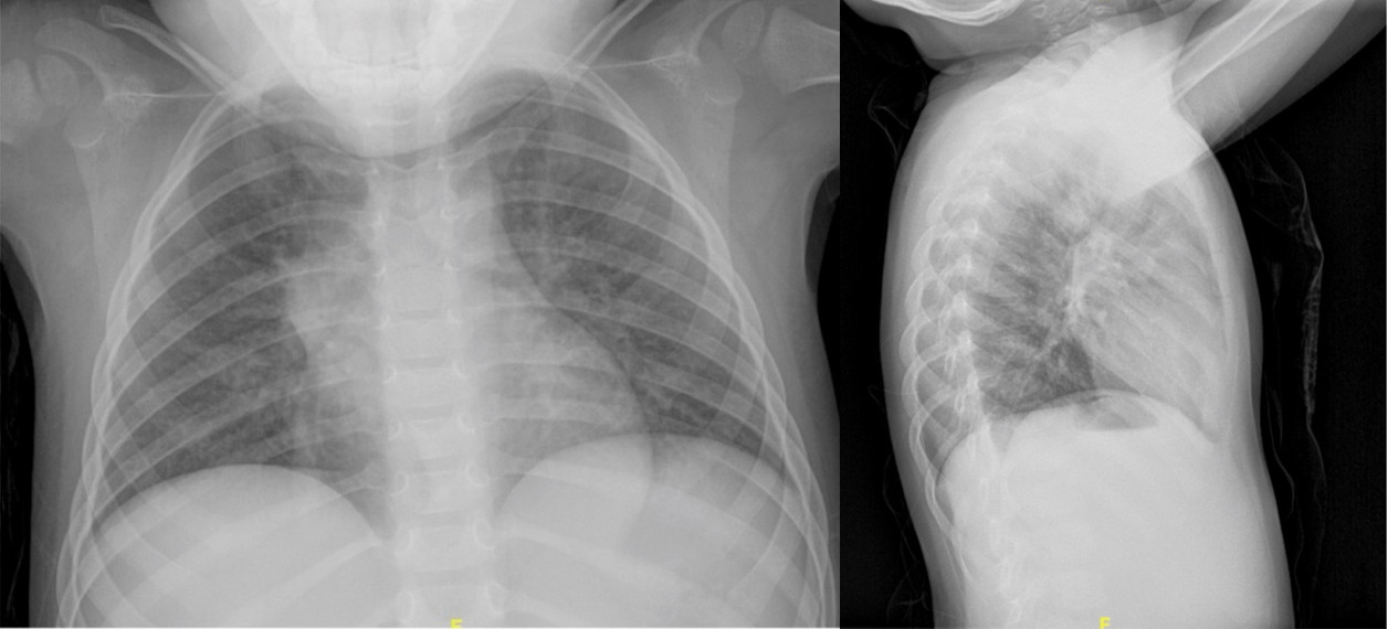Figura 1. Radiografía de tórax en la que se evidencia un llamativo engrosamiento hiliar derecho, con desflecamiento e imagen de dudosa cavitación a dicho nivel