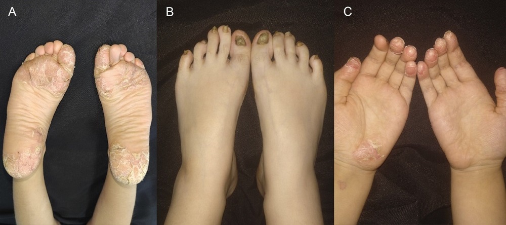 Figura 2. Placas hiperqueratósicas palmoplantares con grietas e hiperqueratosis en las uñas de los pies