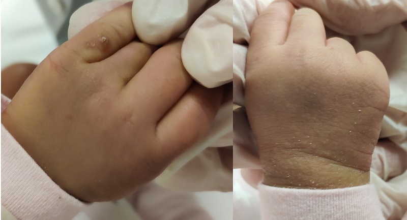 Figura 1. Imagen clínica. Pápulas eritematosas acompañadas de pústulas aisladas en dorso de ambas manos
