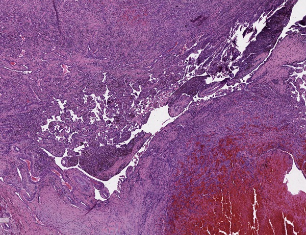 Figura 1. Hematoxilina y eosina 25×. Proliferación papilar intravascular, en relación con trombo en organización.