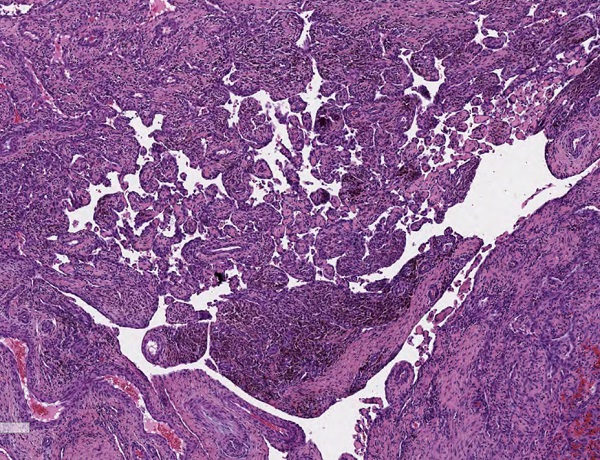 Figura 2. Hematoxicilina y eosina 40×. Proliferación papilar intravascular.