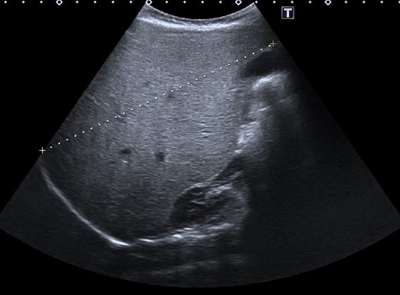 Figura 1. Gran hepatomegalia con hiperecogenicidad difusa. Se muestra el eje longitudinal del hígado (14,3 cm), muy aumentado de tamaño para la edad de la menor