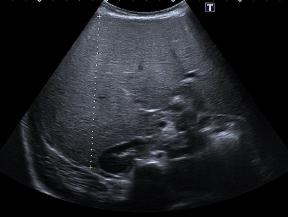 Figura 2. Eje anteroposterior del hígado (11,2 cm), también muy aumentado de tamaño para la edad de la menor, en un contexto de hiperecogenicidad difusa