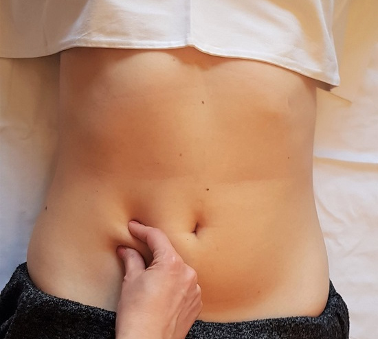 Figura 2. Pinch test. Al pinzar la grasa abdominal se aprecia un aumento excesivo del dolor, en comparación con el lado contralateral