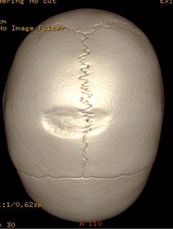 Figura 2. Reconstrucción de la tomografía computarizada en 3D donde se aprecia el defecto óseo a nivel de la calota de unos 5 cm
