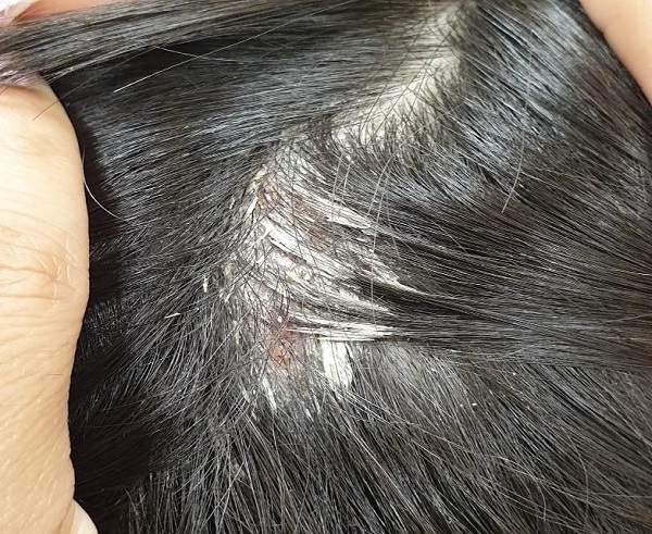 Figura 1. Lesiones del cuero cabelludo