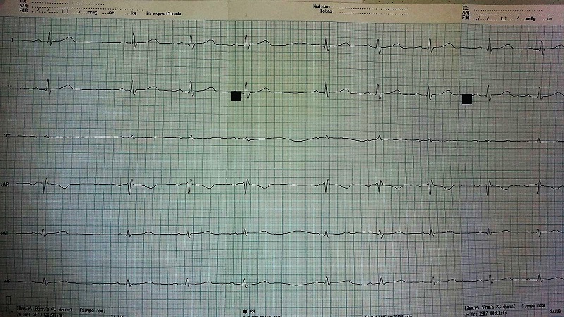 Figura 1. Electrocardiograma realizado a su llegada al centro de salud