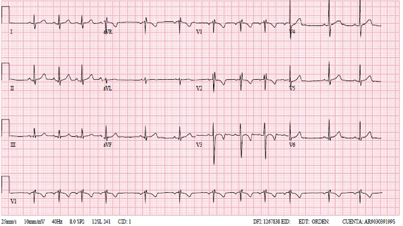 Figura 2. Electrocardiograma realizado en Consultas de Cardiología Pediátrica