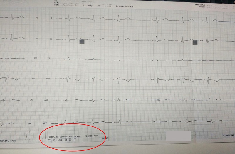 Figura 3. Electrocardiograma realizado en el centro de salud a velocidad de 50 mm/s