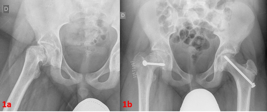 Figura 1. A: radiografía anteroposterior de la cadera derecha. Se aprecia desplazamiento anterosuperior de la metáfisis proximal respecto a la epífisis. B: cambios posquirúrgicos por reducción de ECF derecho con material de osteosíntesis (tornillos)