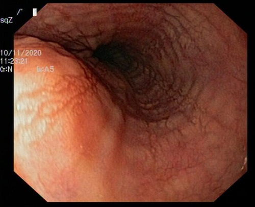 Figura 1. Endoscopia esofágica en la que se aprecia estriaciones longitudinales con tendencia a la traquealización
