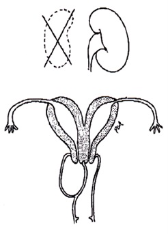 Figura 2. Representación de útero bicorne, obstrucción de hemivagina y agenesia renal ipsilateral