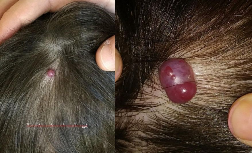 Figura 1. Lesión nodular violácea en cuero cabelludo. Imagen izquierda: abril de 2020. Imagen derecha: noviembre de 2020